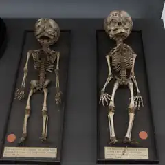 Two fetal skeletons displayed in black trays, labeled with heights and gestational ages, alongside a child's skull on a stand.