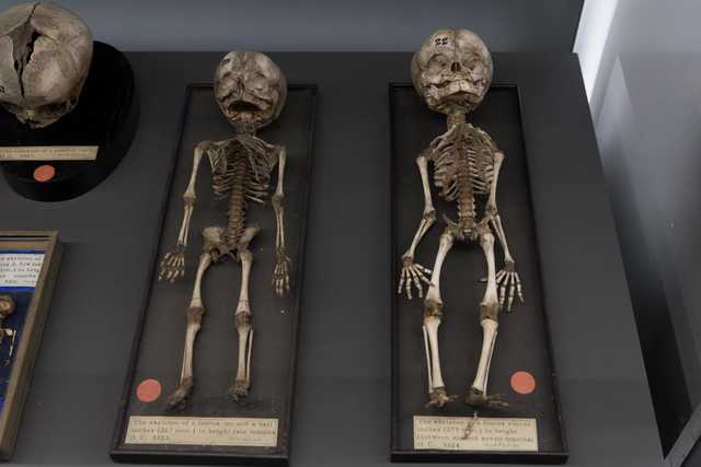 Two fetal skeletons displayed in black trays, labeled with heights and gestational ages, alongside a child's skull on a stand.